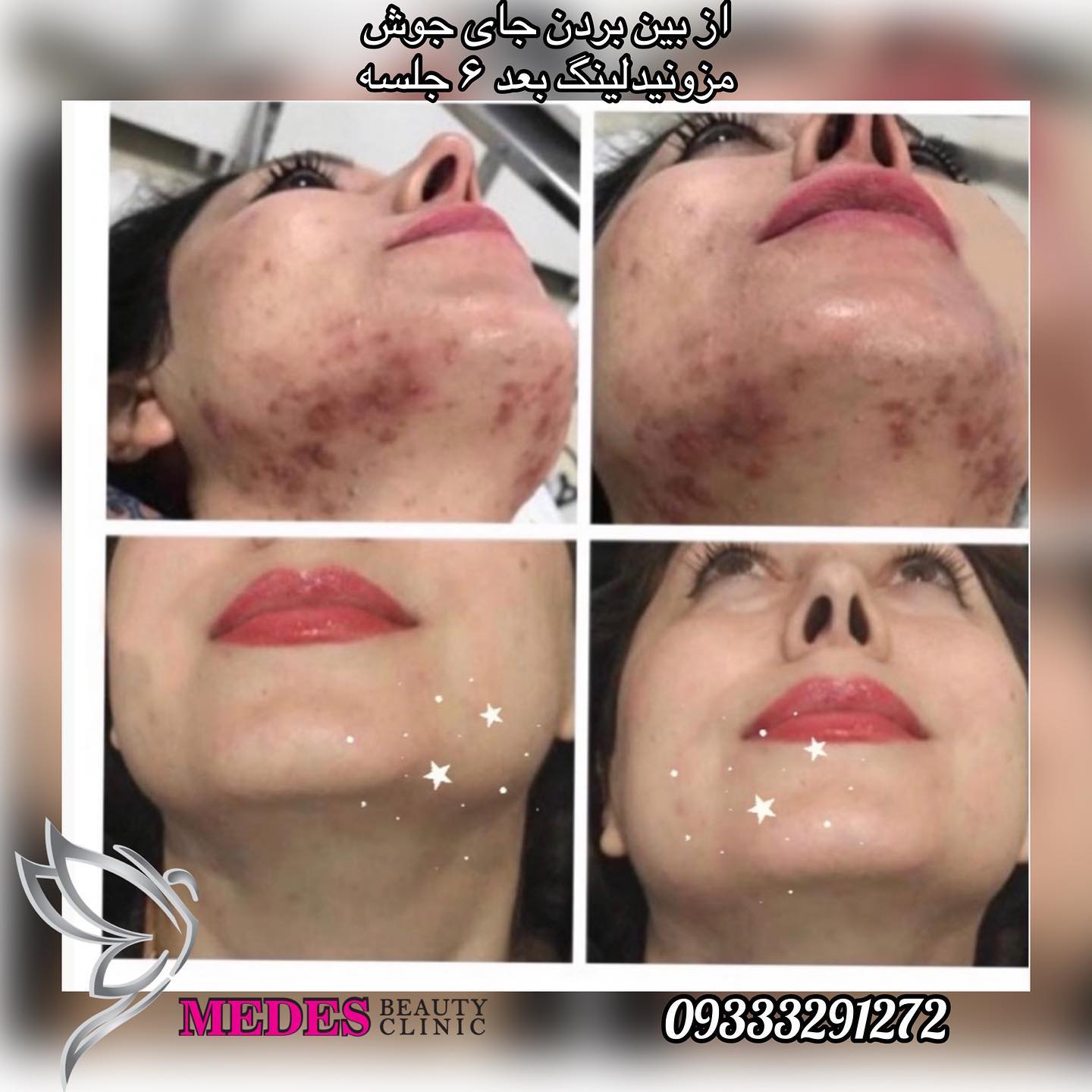 گالری مزونیدلینگ